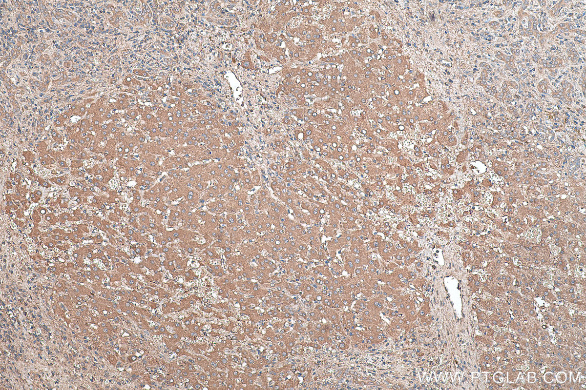 Immunohistochemical analysis of paraffin-embedded human liver cancer tissue slide using KHC0481 (ECM1 IHC Kit).