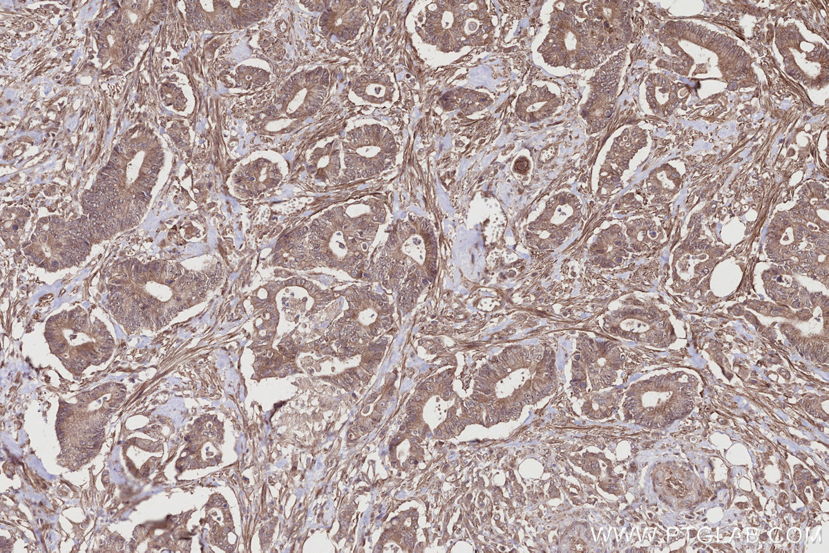 Immunohistochemical analysis of paraffin-embedded human rectal cancer tissue slide using KHC2749 (EDEM1 IHC Kit).