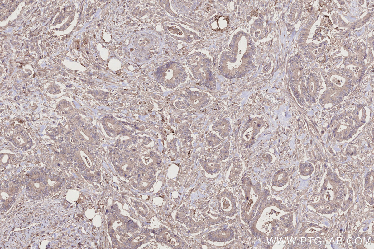 Immunohistochemical analysis of paraffin-embedded human rectal cancer tissue slide using KHC2751 (EDG2/LPAR1 IHC Kit).