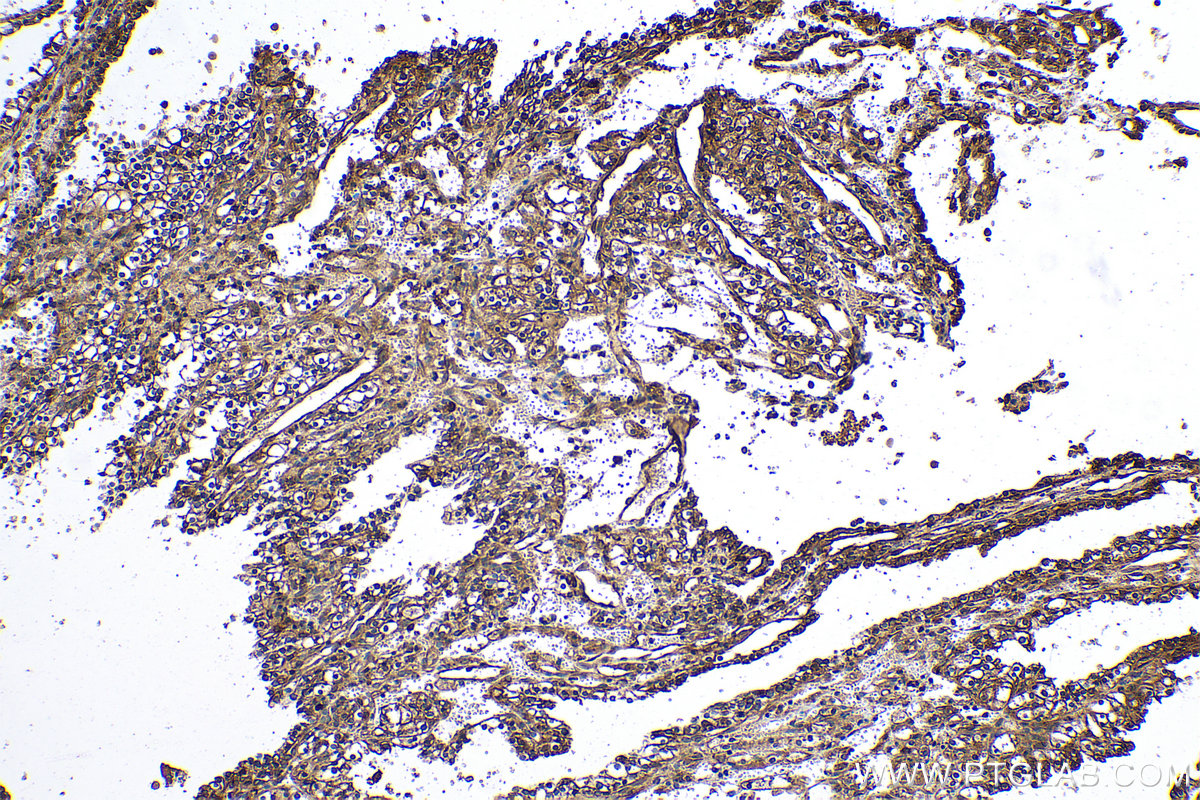 Immunohistochemical analysis of paraffin-embedded human renal cell carcinoma tissue slide using KHC0508 (EEF1A1 IHC Kit).