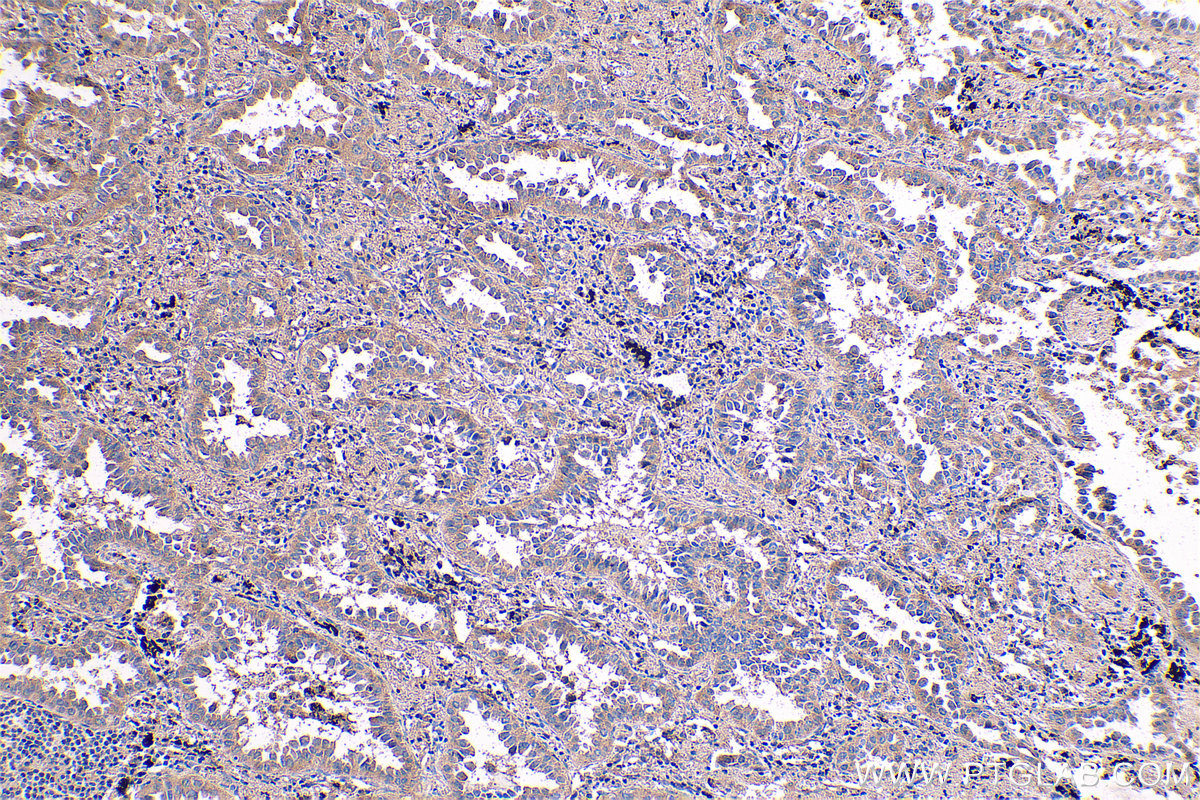 Immunohistochemical analysis of paraffin-embedded human lung cancer tissue slide using KHC0563 (EEF1A2 IHC Kit).