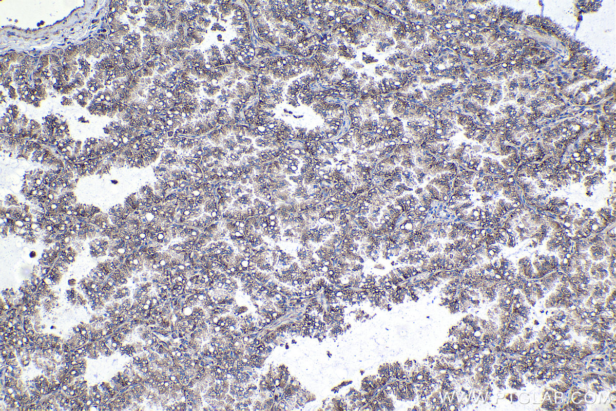 Immunohistochemical analysis of paraffin-embedded human lung cancer tissue slide using KHC1171 (EEF1B2 IHC Kit).