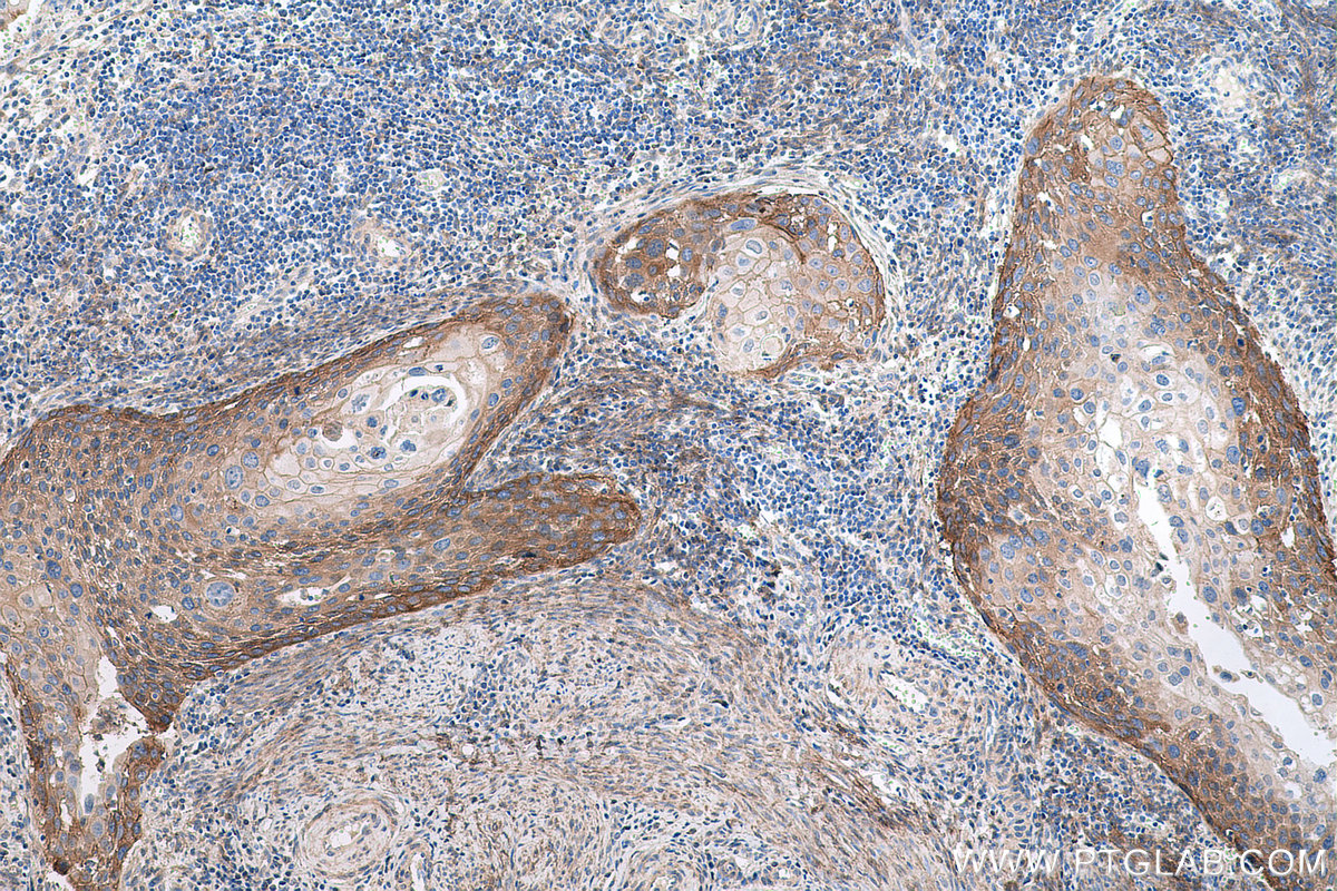 Immunohistochemical analysis of paraffin-embedded human cervical cancer tissue slide using KHC0612 (EGFR IHC Kit).