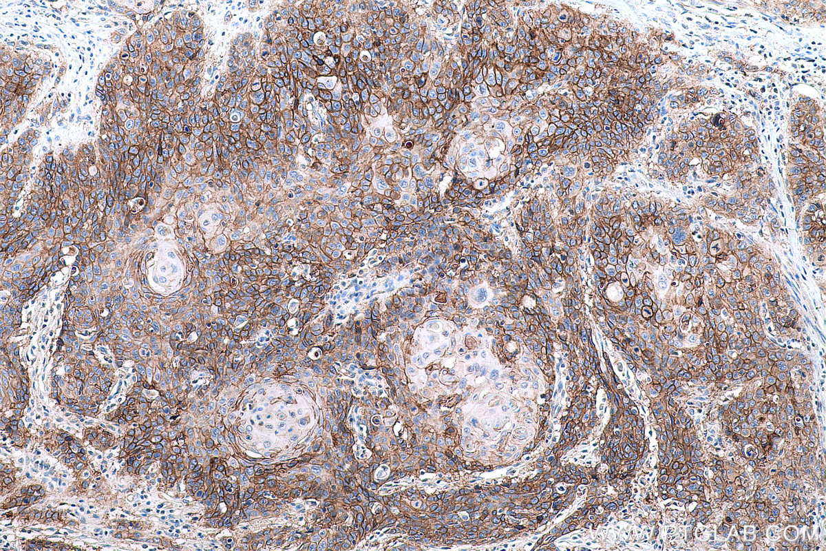 Immunohistochemical analysis of paraffin-embedded human oesophagus cancer tissue slide using KHC0612 (EGFR IHC Kit).
