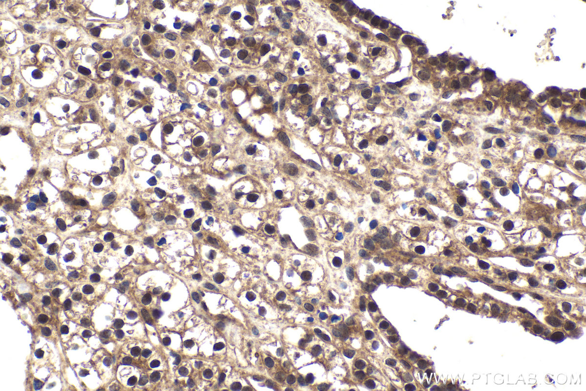Immunohistochemical analysis of paraffin-embedded human renal cell carcinoma tissue slide using KHC1935 (EGLN3 IHC Kit).