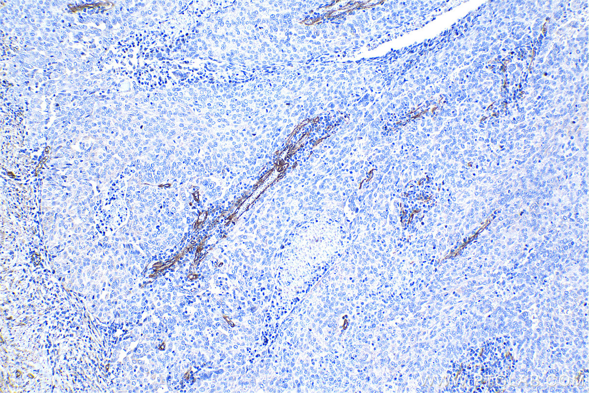 Immunohistochemical analysis of paraffin-embedded human ovary tumor tissue slide using KHC1291 (EHD2 IHC Kit).