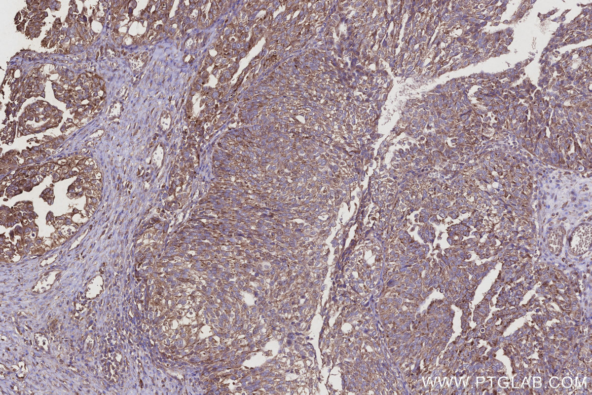 Immunohistochemical analysis of paraffin-embedded human ovary cancer tissue slide using KHC2855 (EIF2AK1 IHC Kit).
