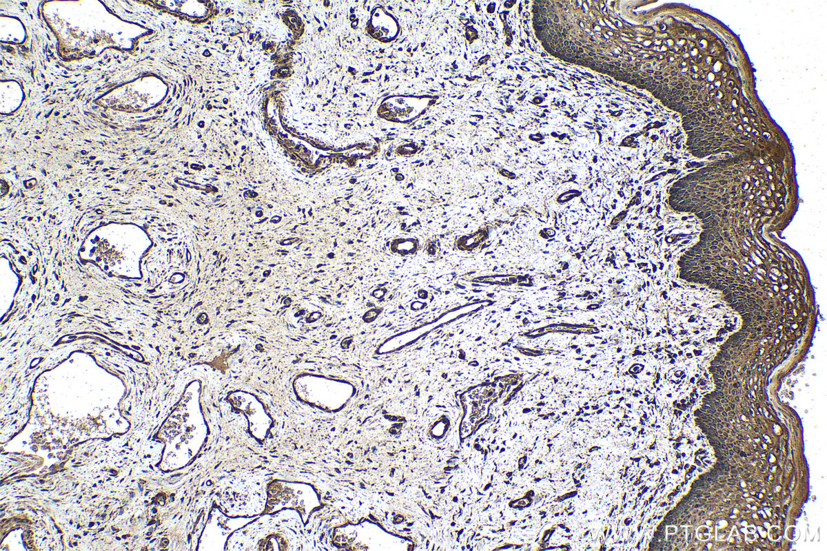 Immunohistochemical analysis of paraffin-embedded human cervical cancer tissue slide using KHC1546 (EIF2AK2, PKR IHC Kit).