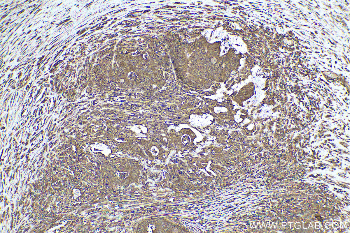 Immunohistochemical analysis of paraffin-embedded human colon cancer tissue slide using KHC0796 (EIF2C1 IHC Kit).