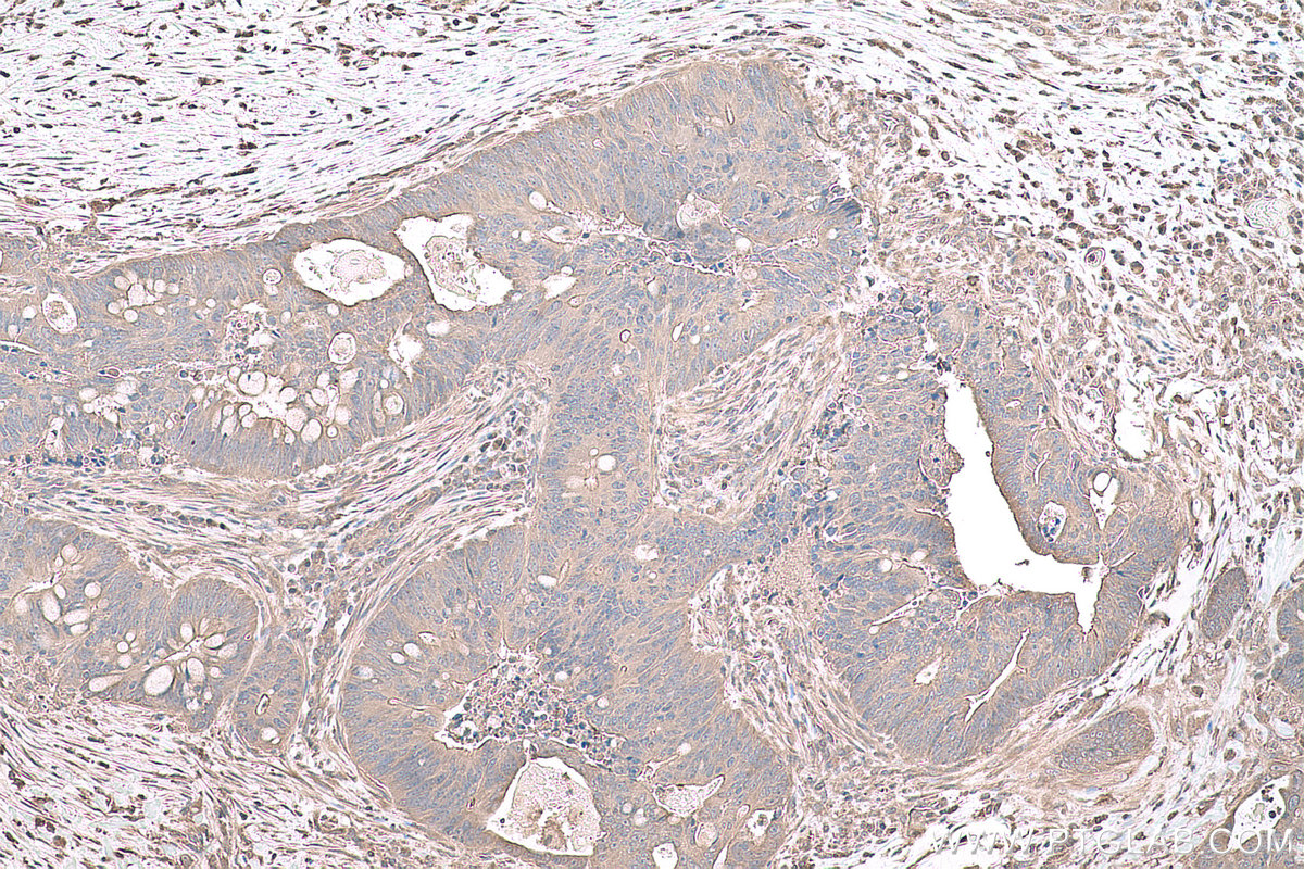 Immunohistochemical analysis of paraffin-embedded human colon cancer tissue slide using KHC0798 (EIF2C3 IHC Kit).