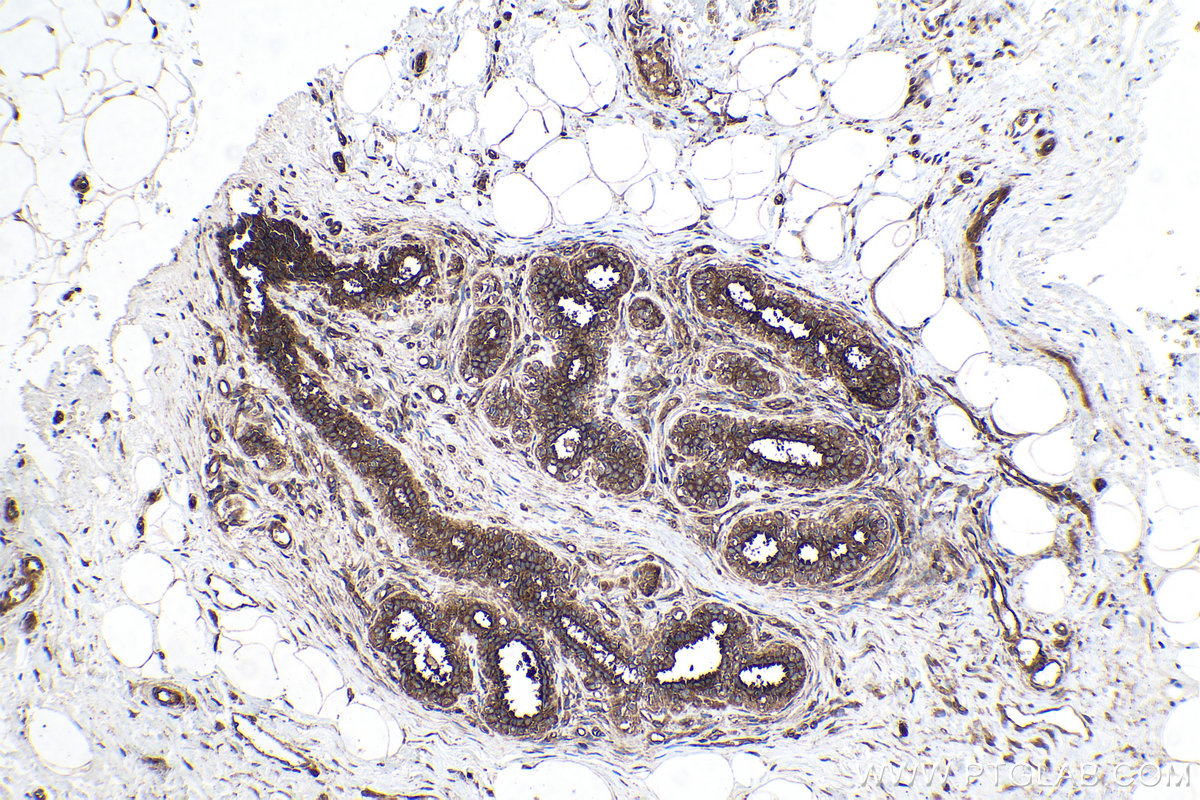 Immunohistochemical analysis of paraffin-embedded human breast cancer tissue slide using KHC0167 (EIF3A IHC Kit).