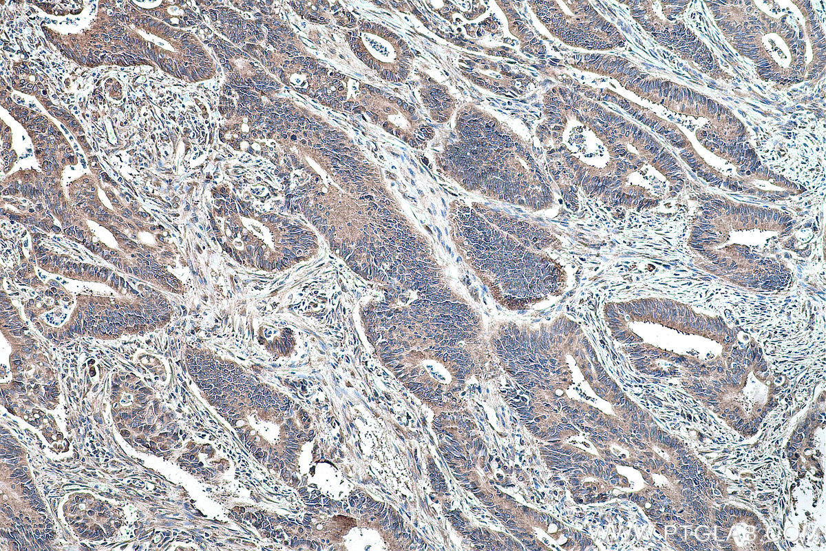 Immunohistochemical analysis of paraffin-embedded human colon cancer tissue slide using KHC0169 (EIF3D IHC Kit).