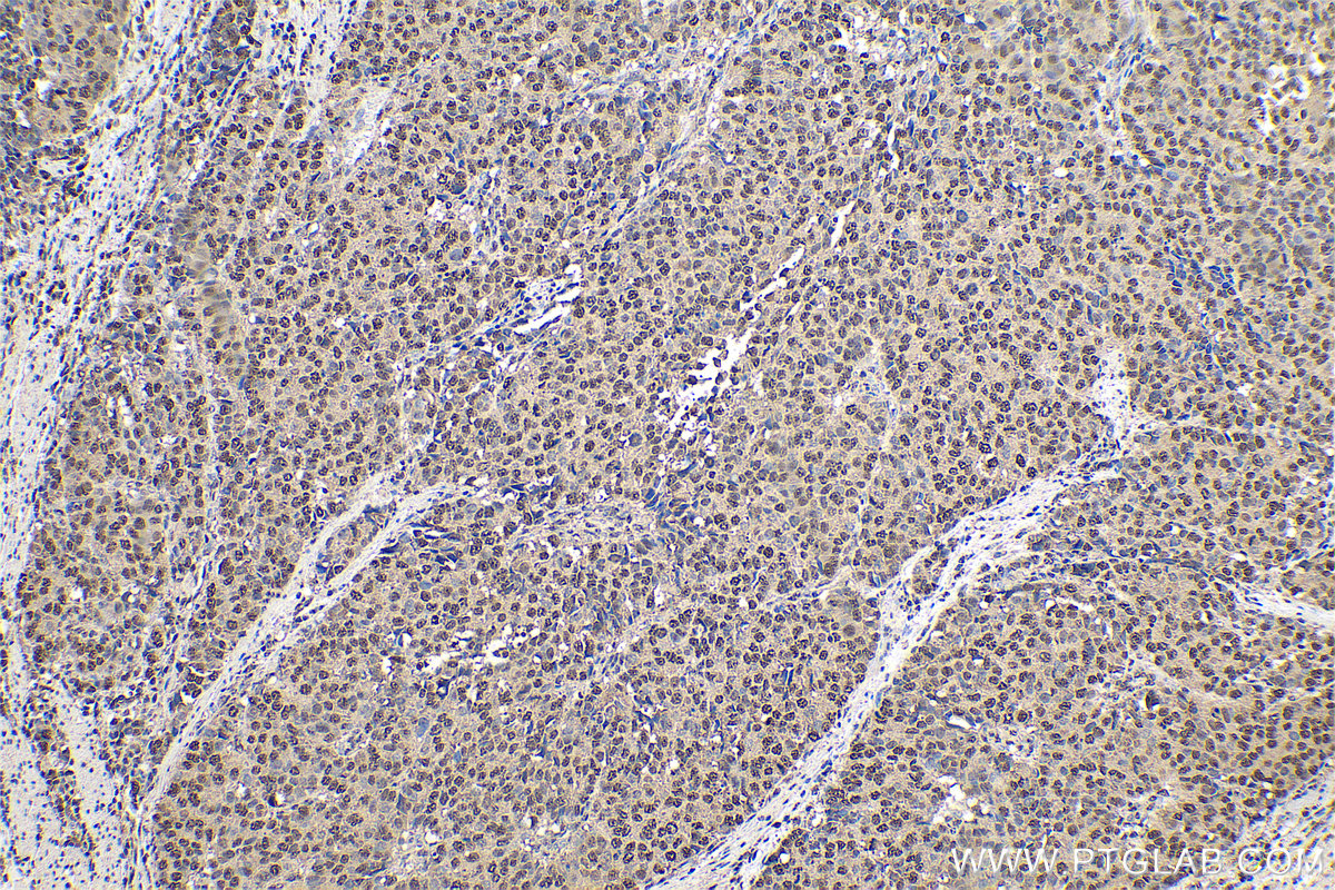 Immunohistochemical analysis of paraffin-embedded human stomach cancer tissue slide using KHC0778 (EIF3E IHC Kit).