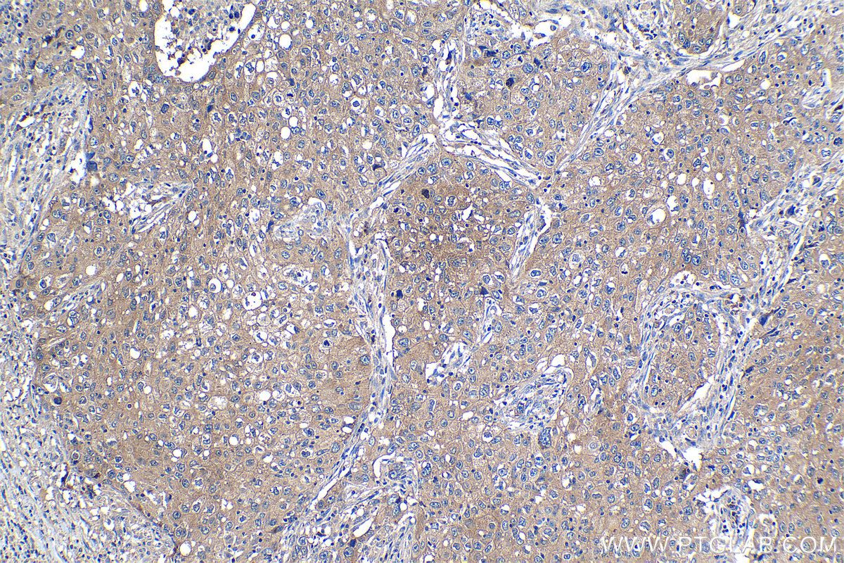 Immunohistochemical analysis of paraffin-embedded human lung cancer tissue slide using KHC1204 (EIF4A2 IHC Kit).