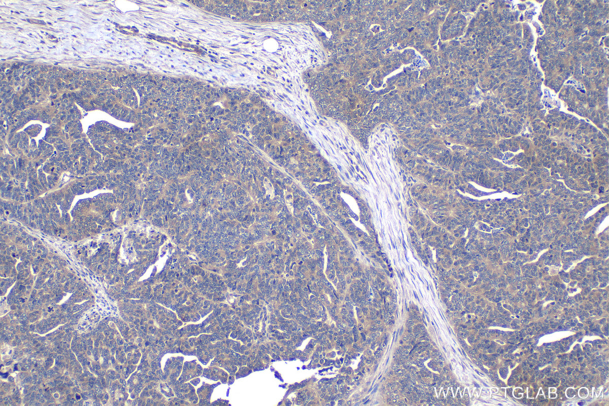 Immunohistochemical analysis of paraffin-embedded human ovary tumor tissue slide using KHC1205 (EIF4E IHC Kit).