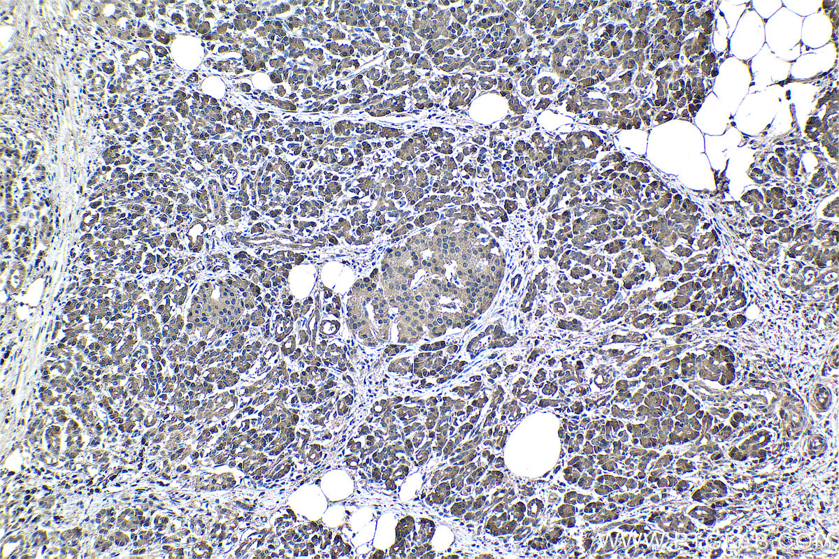 Immunohistochemical analysis of paraffin-embedded human pancreas cancer tissue slide using KHC0973 (EIF4EBP1 IHC Kit).