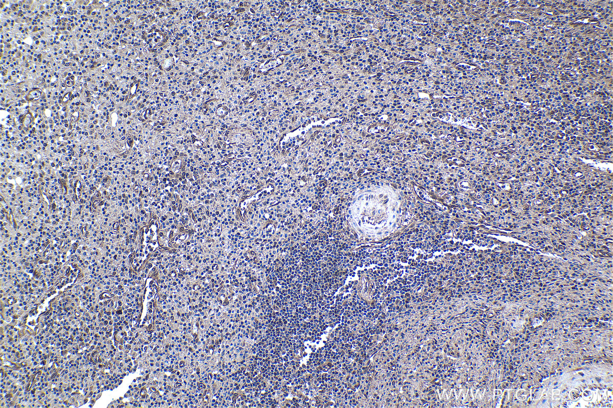 Immunohistochemical analysis of paraffin-embedded human colon cancer tissue slide using KHC0973 (EIF4EBP1 IHC Kit).