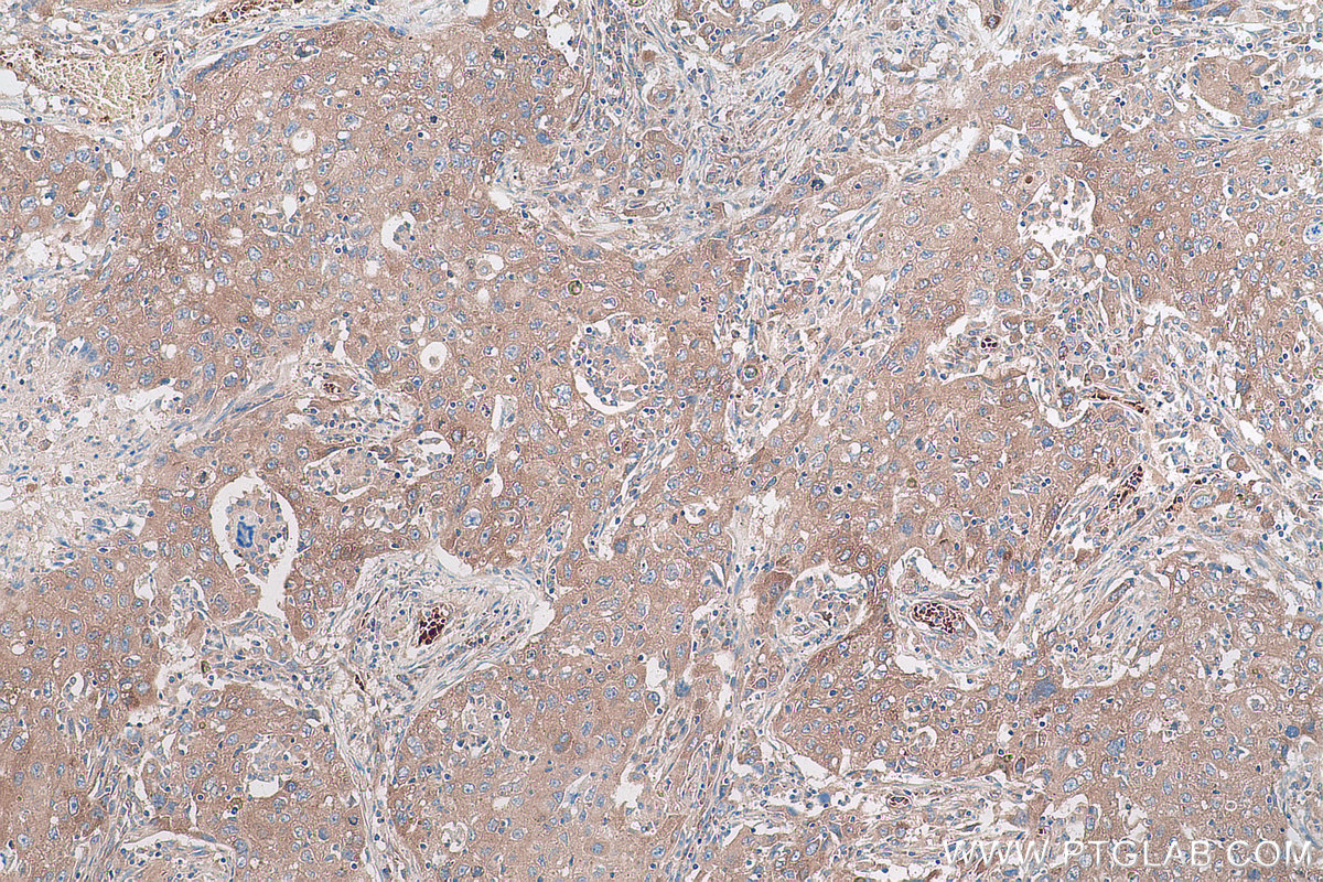 Immunohistochemical analysis of paraffin-embedded human lung cancer tissue slide using KHC0927 (EIF4G2 IHC Kit).