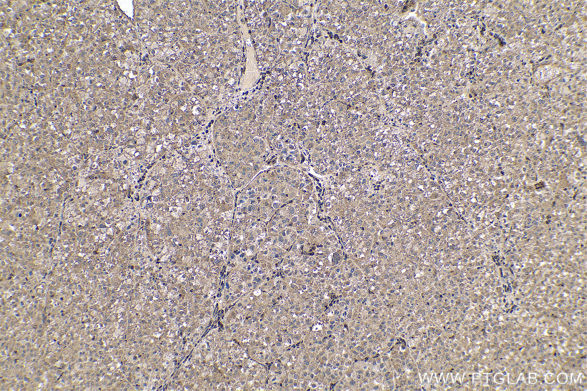 Immunohistochemical analysis of paraffin-embedded human liver cancer tissue slide using KHC0596 (EIF5A IHC Kit).