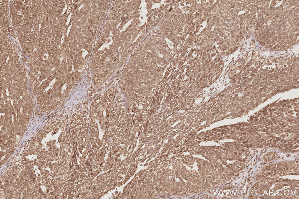 Immunohistochemical analysis of paraffin-embedded human ovary cancer tissue slide using KHC2896 (EIF5A1/EIF5A2 IHC Kit).