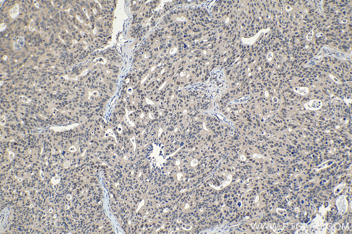 Immunohistochemical analysis of paraffin-embedded human ovary tumor tissue slide using KHC1107 (ELAC2 IHC Kit).