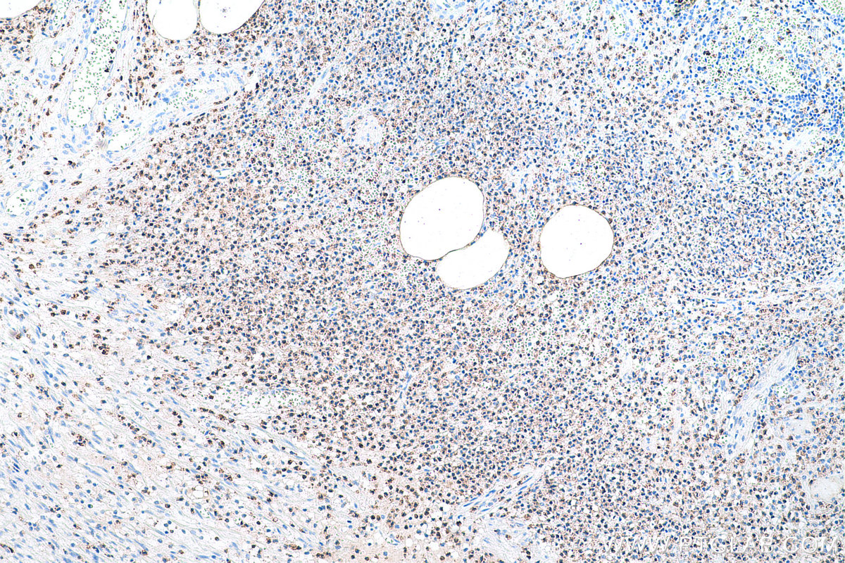 Immunohistochemical analysis of paraffin-embedded human appendicitis tissue slide using KHC0695 (ELANE/ELA2 IHC Kit).