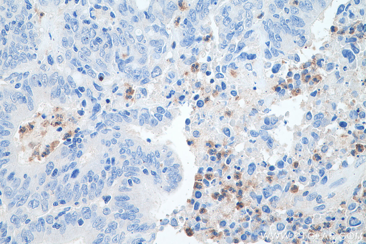 Immunohistochemical analysis of paraffin-embedded human colon cancer tissue slide using KHC0695 (ELANE/ELA2 IHC Kit).
