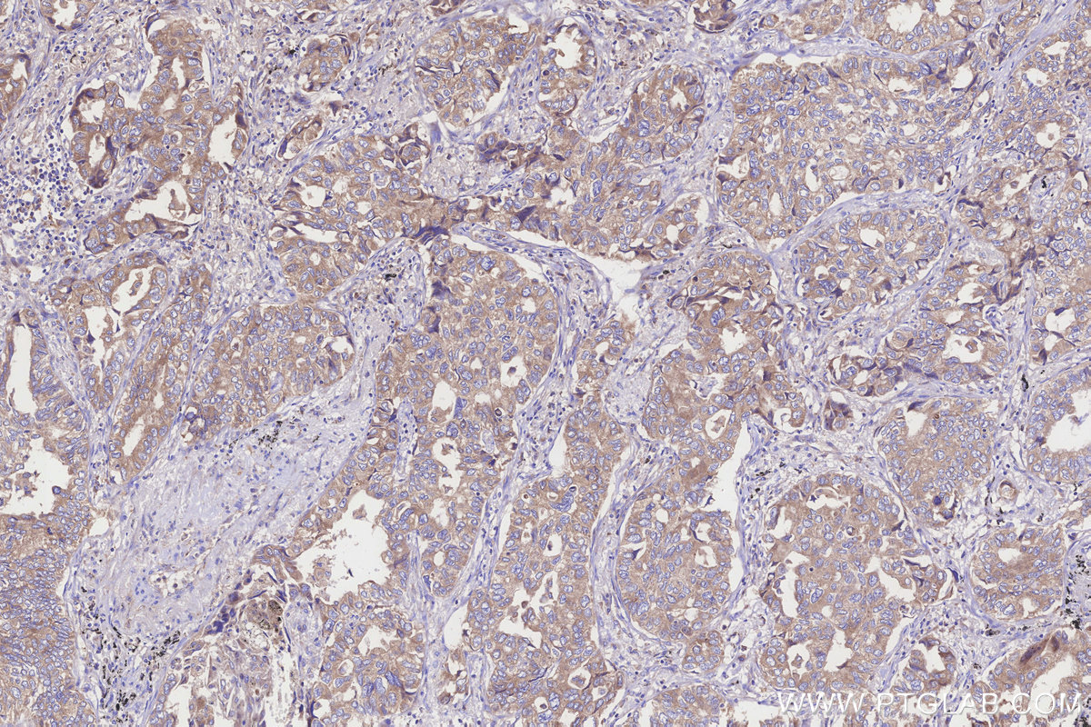 Immunohistochemical analysis of paraffin-embedded human lung cancer tissue slide using KHC3254 (EMC2/TTC35 IHC Kit).