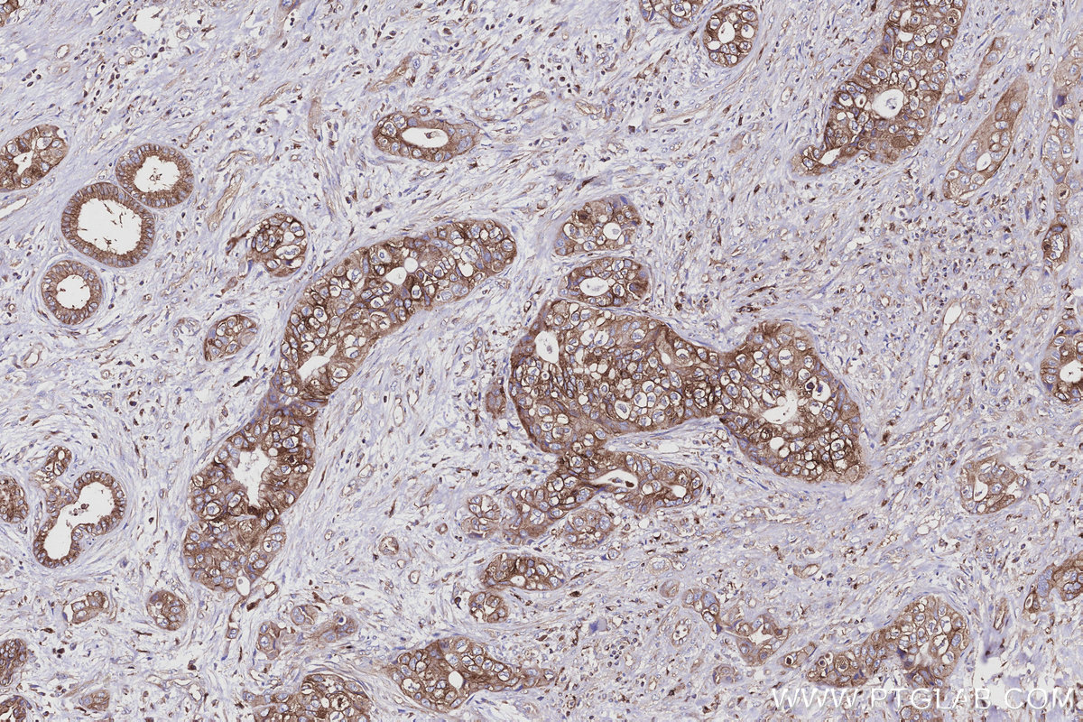 Immunohistochemical analysis of paraffin-embedded human pancreas cancer tissue slide using KHC2931 (EML4 IHC Kit). Immunohistochemical analysis of paraffin-embedded human pancreas cancer tissue slide using KHC2931 (EML4 IHC Kit).