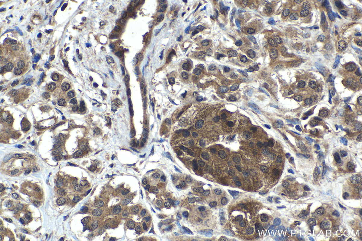 Immunohistochemical analysis of paraffin-embedded human pancreas cancer tissue slide using KHC1426 (ENC1 IHC Kit).