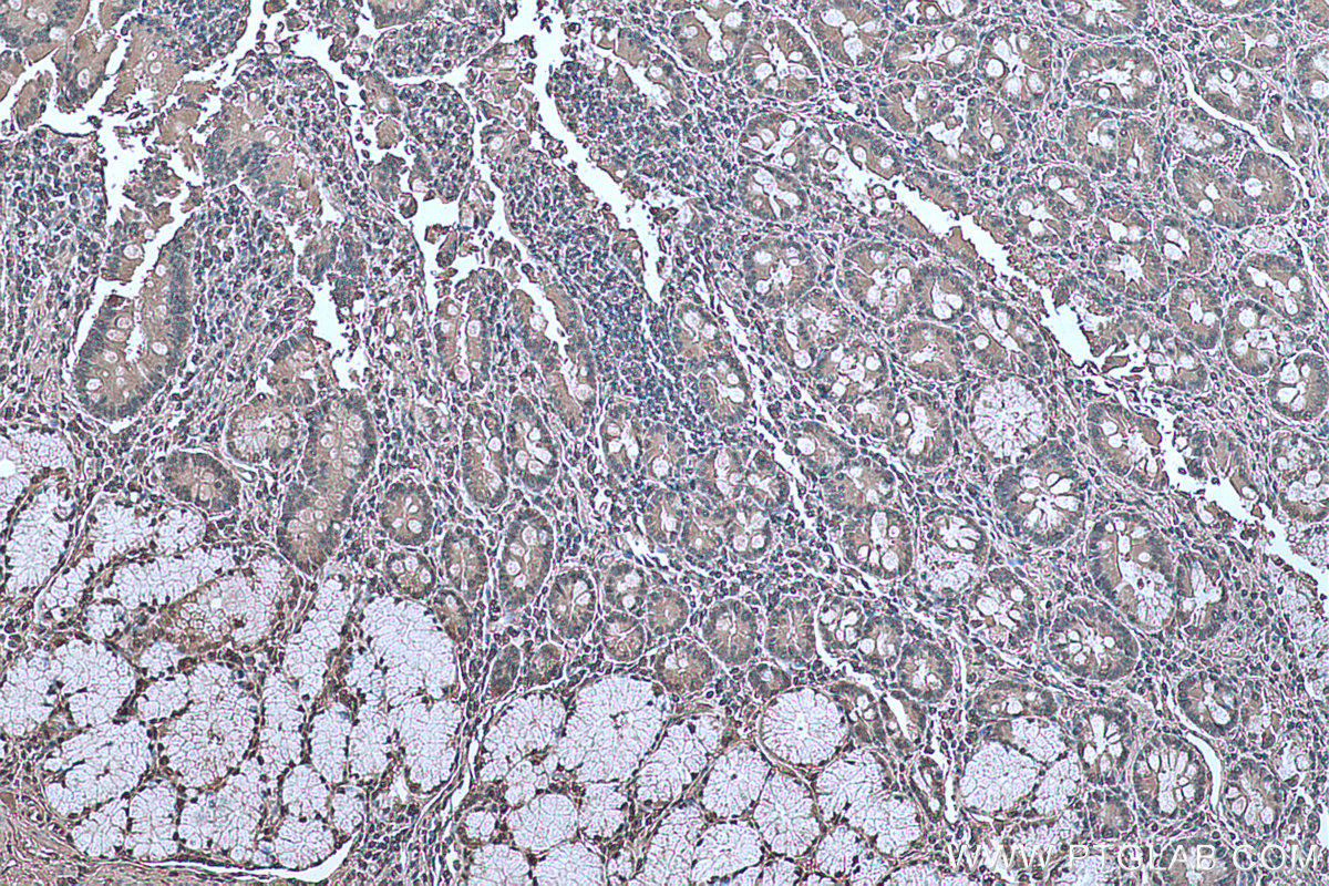 Immunohistochemical analysis of paraffin-embedded human stomach cancer tissue slide using KHC0656 (ENO1 IHC Kit).