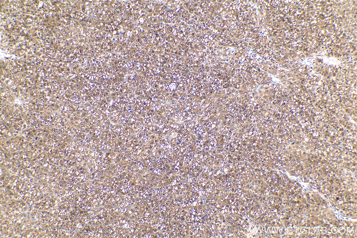 Immunohistochemical analysis of paraffin-embedded human liver cancer tissue slide using KHC0587 (ENO3 IHC Kit).