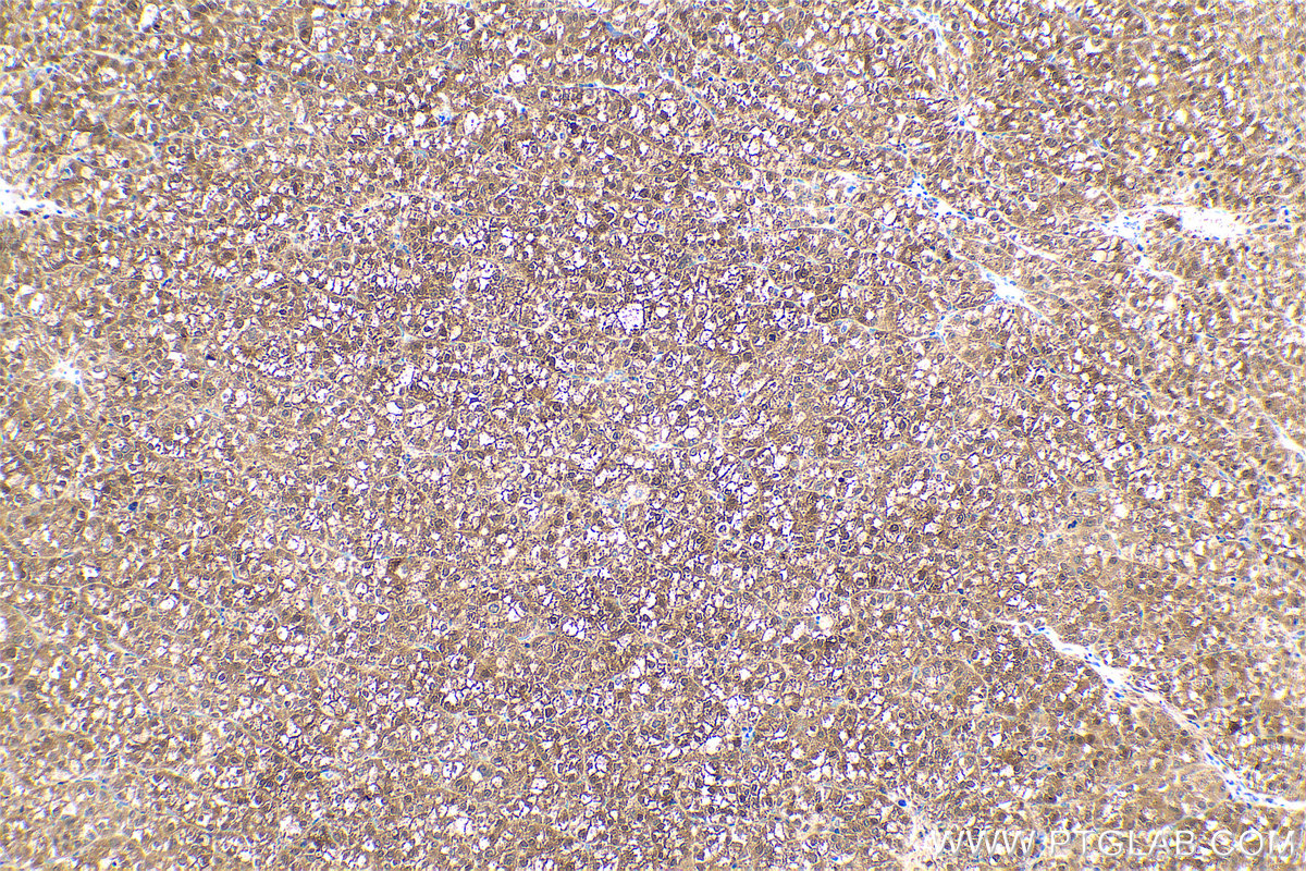 Immunohistochemical analysis of paraffin-embedded human liver cancer tissue slide using KHC0587 (ENO3 IHC Kit).
