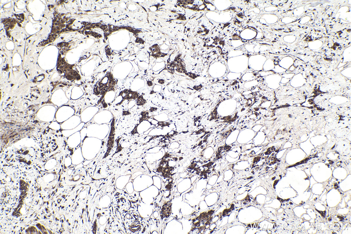 Immunohistochemical analysis of paraffin-embedded human urothelial carcinoma tissue slide using KHC1688 (EP300 IHC Kit).