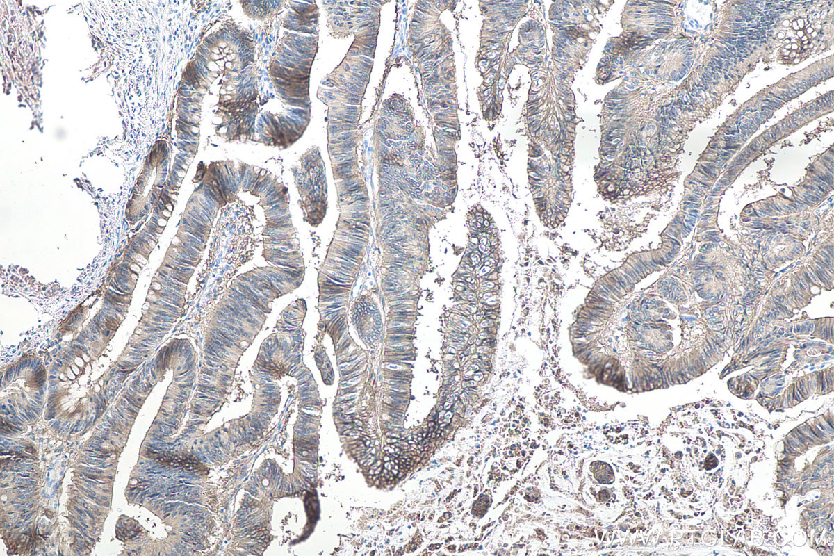 Immunohistochemical analysis of paraffin-embedded human colon cancer tissue slide using KHC0085 (EPCAM IHC Kit).