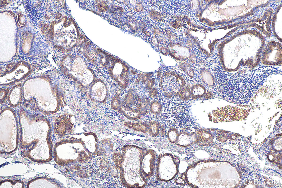 Immunohistochemical analysis of paraffin-embedded human thyroid cancer tissue slide using KHC0085 (EPCAM/CD326 IHC Kit).