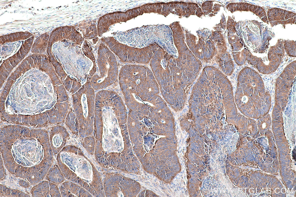 Immunohistochemical analysis of paraffin-embedded human colon cancer tissue slide using KHC0869 (EPRS IHC Kit).