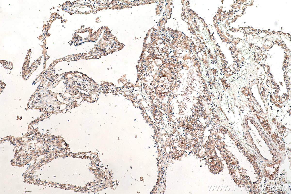 Immunohistochemical analysis of paraffin-embedded human renal cell carcinoma tissue slide using KHC0869 (EPRS IHC Kit).