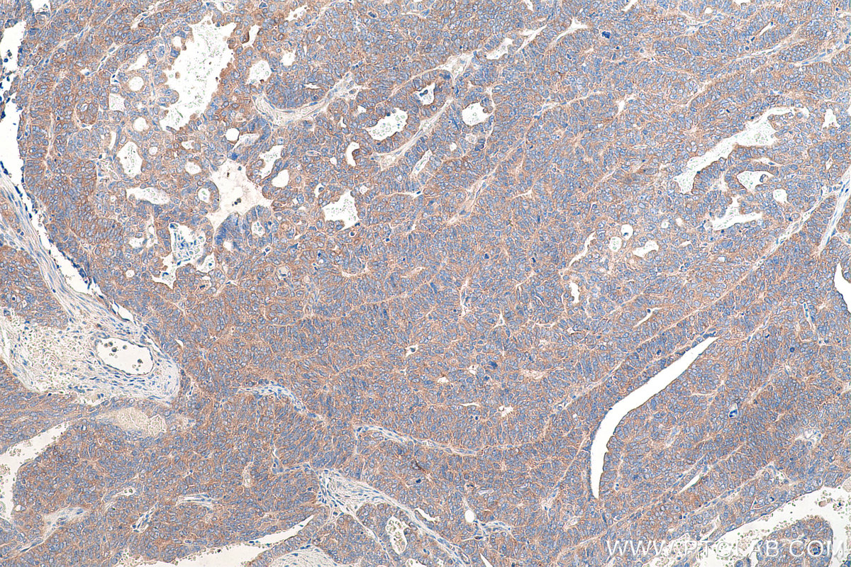 Immunohistochemical analysis of paraffin-embedded human ovary tumor tissue slide using KHC0869 (EPRS IHC Kit).