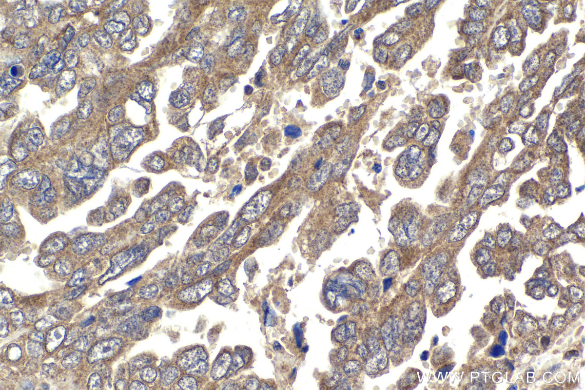 Immunohistochemical analysis of paraffin-embedded human ovary tumor tissue slide using KHC1883 (ERBIN IHC Kit).