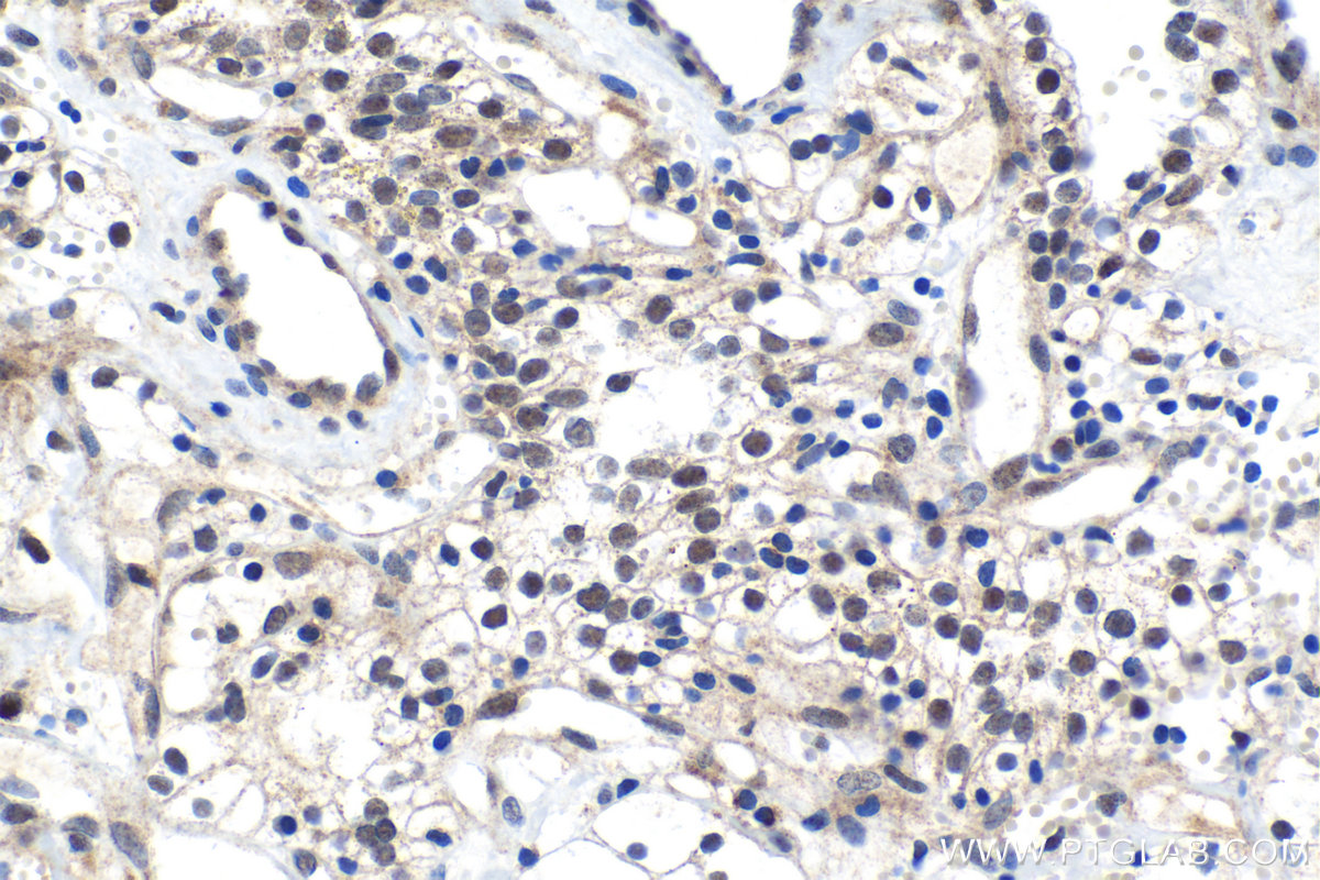 Immunohistochemical analysis of paraffin-embedded human renal cell carcinoma tissue slide using KHC1525 (ESRRA IHC Kit).