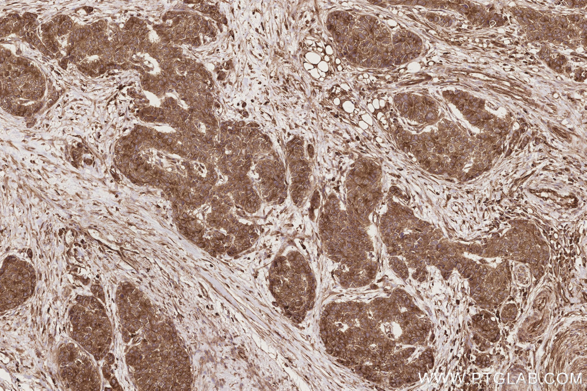 Immunohistochemical analysis of paraffin-embedded human stomach cancer tissue slide using KHC2861 (ESYT1 IHC Kit).