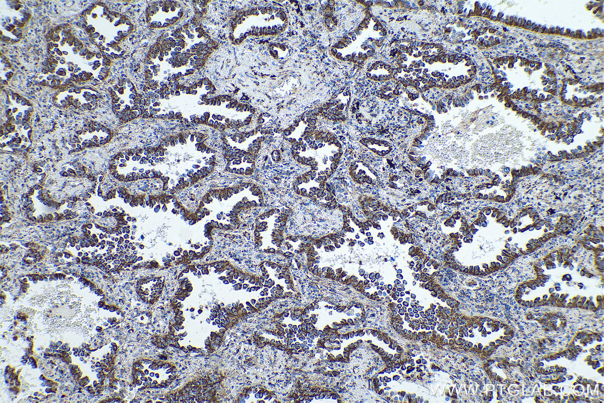 Immunohistochemical analysis of paraffin-embedded human lung cancer tissue slide using KHC0544 (ETFA IHC Kit).