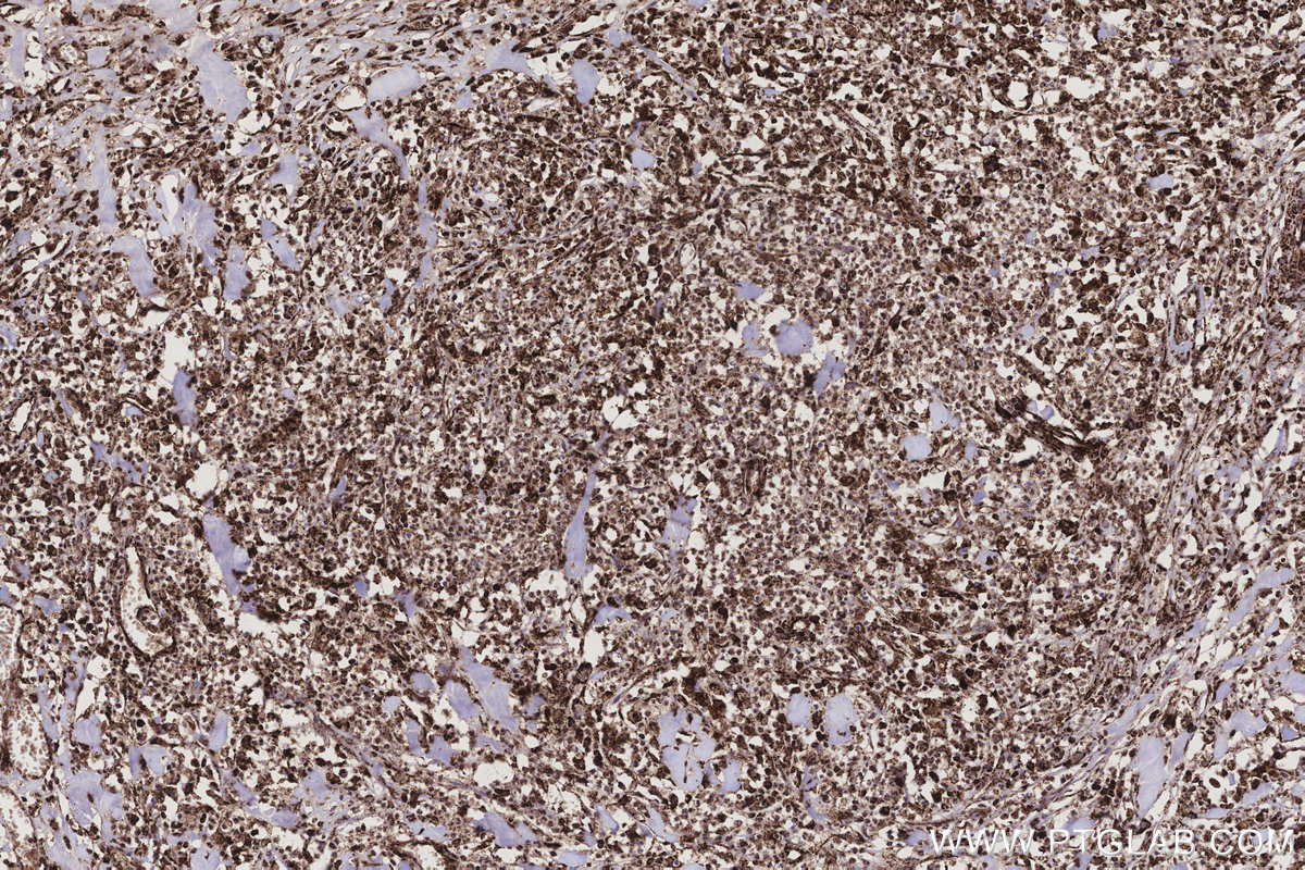 Immunohistochemical analysis of paraffin-embedded human colon cancer tissue slide using KHC3207 (ETFB IHC Kit). Immunohistochemical analysis of paraffin-embedded human colon cancer tissue slide using KHC3207 (ETFB IHC Kit).