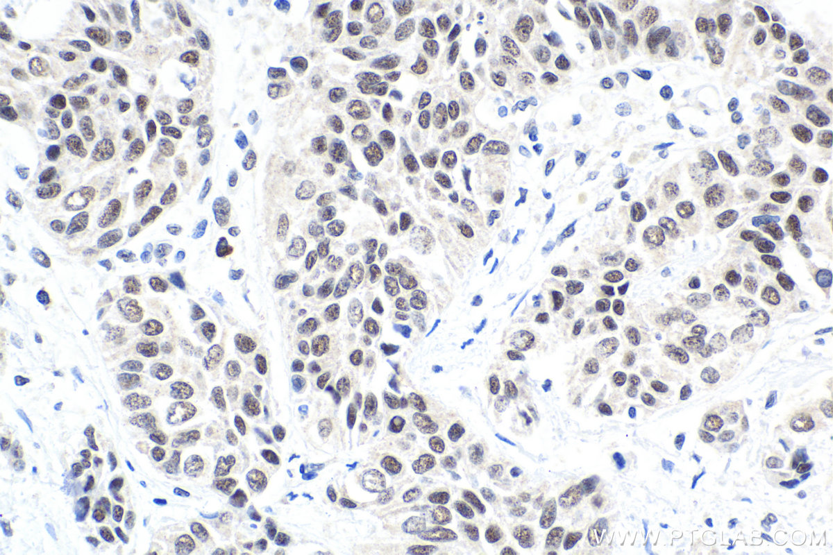 Immunohistochemical analysis of paraffin-embedded human urothelial carcinoma tissue slide using KHC1606 (ETV5 IHC Kit).