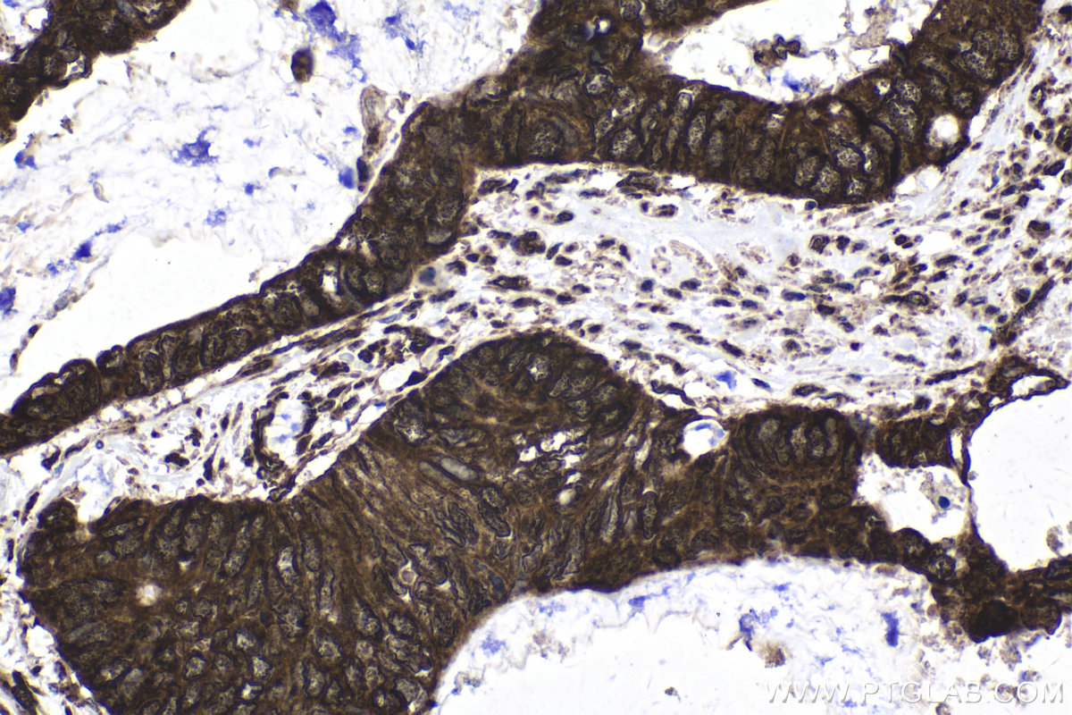 Immunohistochemical analysis of paraffin-embedded human urothelial carcinoma tissue slide using KHC1667 (EWSR1/EWS IHC Kit).