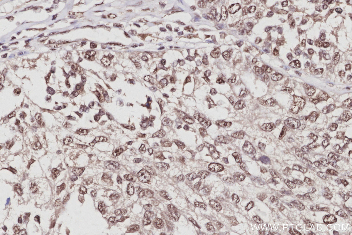 Immunohistochemical analysis of paraffin-embedded human ovary cancer tissue slide using KHC3061 (EXOSC1 IHC Kit). Immunohistochemical analysis of paraffin-embedded human ovary cancer tissue slide using KHC3061 (EXOSC1 IHC Kit).