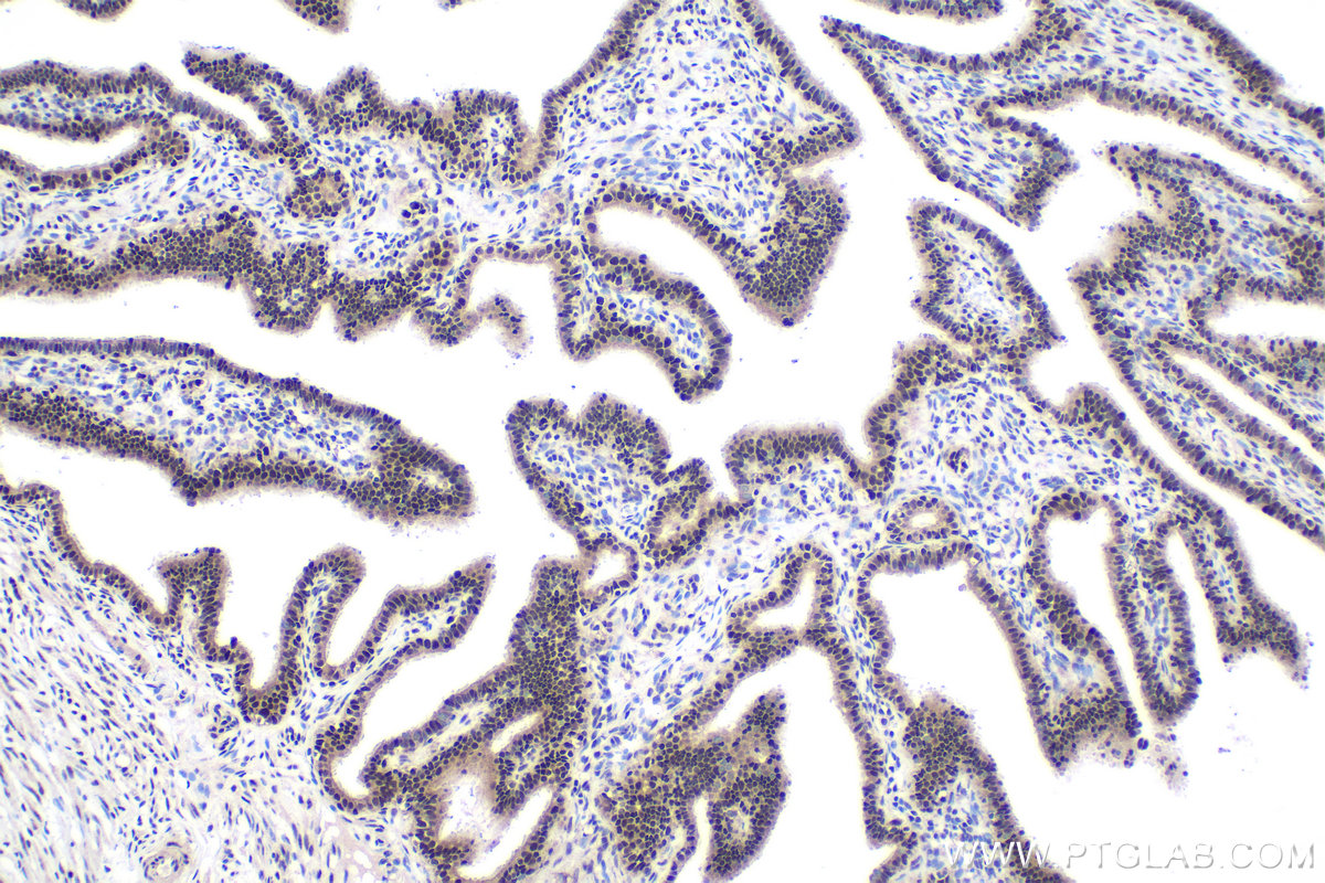 Immunohistochemical analysis of paraffin-embedded human ovary tumor tissue slide using KHC1960 (EXOSC3 IHC Kit).