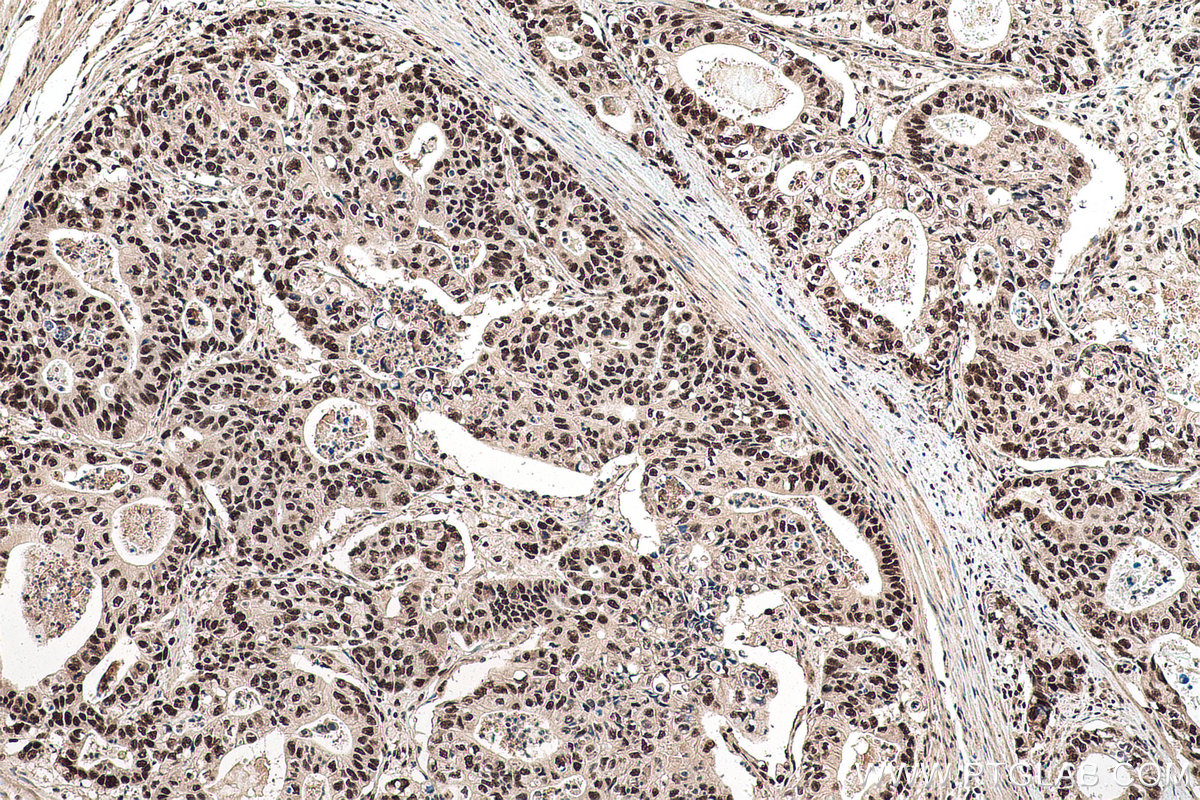 Immunohistochemical analysis of paraffin-embedded human stomach cancer tissue slide using KHC0955 (EXOSC7 IHC Kit).