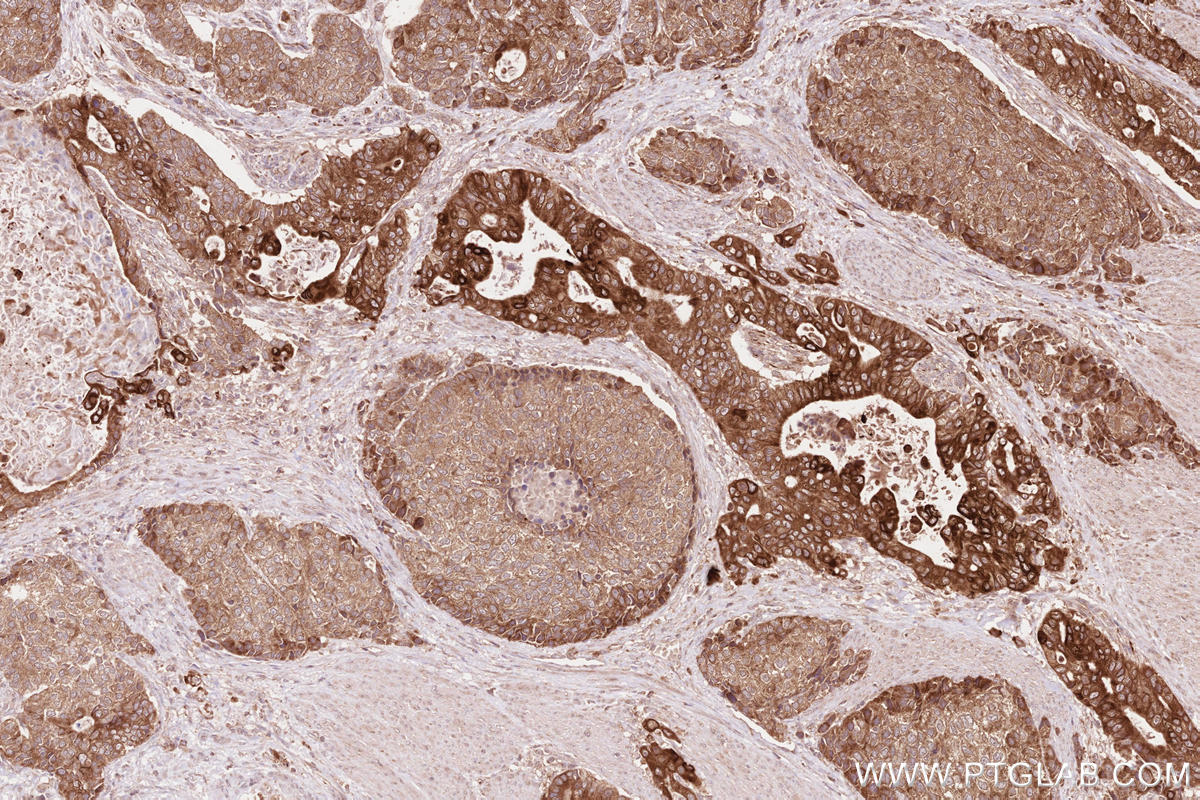 Immunohistochemical analysis of paraffin-embedded human stomach cancer tissue slide using KHC2613 (FA2H IHC Kit).